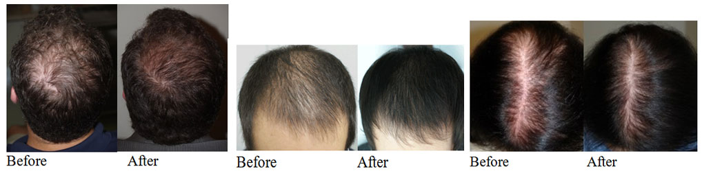 Hair Loss Treatment with PRP & Stem Cells in Phoenix ...